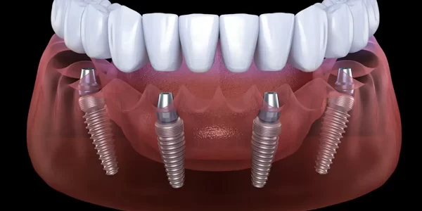 implantaciya-zubov-na-4-implantah-tehnologiya-all-4-01